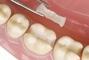 Стомадеус, стоматологическая клиника - Керамическая вкладка