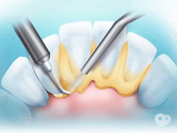 Стомадеус, стоматологічна клініка - Зняття зубних відкладень