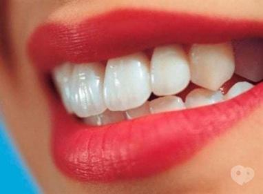 Стомадеус, стоматологічна клініка - Реставрація