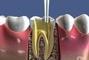 Стомадеус, стоматологическая клиника - Временное пломбирование корневых каналов