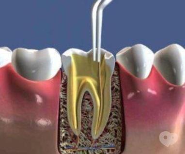 Стомадеус, стоматологічна клініка - Тимчасове пломбування кореневих каналів