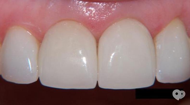 Стомадеус, стоматологическая клиника - Цільнокерамічна прессованная коронка