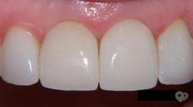 Стомадеус, стоматологическая клиника - Цільнокерамічна прессованная коронка