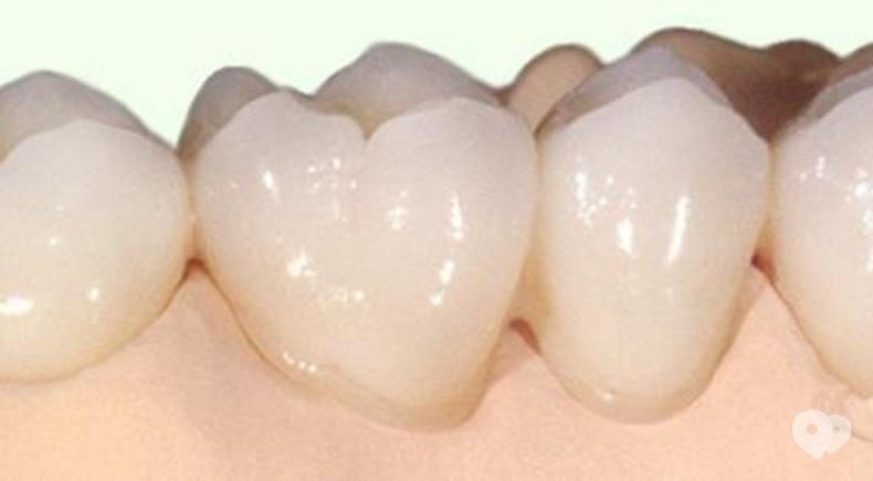 Стомадеус, стоматологічна клініка - Цільнокерамічна коронка на оксиді цирконію