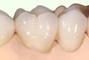 Стомадеус, стоматологическая клиника - Цільнокерамічна коронка на оксиде циркония