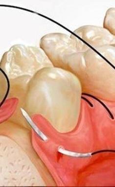 Стомадеус, стоматологічна клініка - Накладання швів