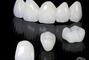 Стомадеус, стоматологічна клініка - Металокерамічна коронка