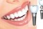 Стомадеус, стоматологічна клініка - Встановлення імпланта