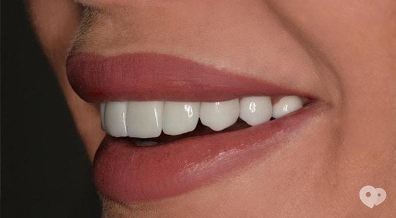 Стомадеус, стоматологічна клініка - Вініри