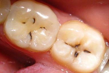 7 зірок, стоматологія - Лікування середнього карієсу