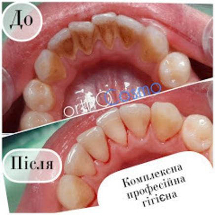 ORTHOCOSMO, Ортодонтический комплекс современных стандартов врача Ковита И.С. ORTHOCOSMO - Чистка ультразвуком