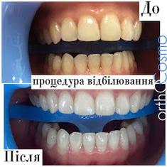 ORTHOCOSMO, Ортодонтичний комплекс сучасних стандартів лікаря Ковіти І.С. ORTHOCOSMO - Відбілювання зубів